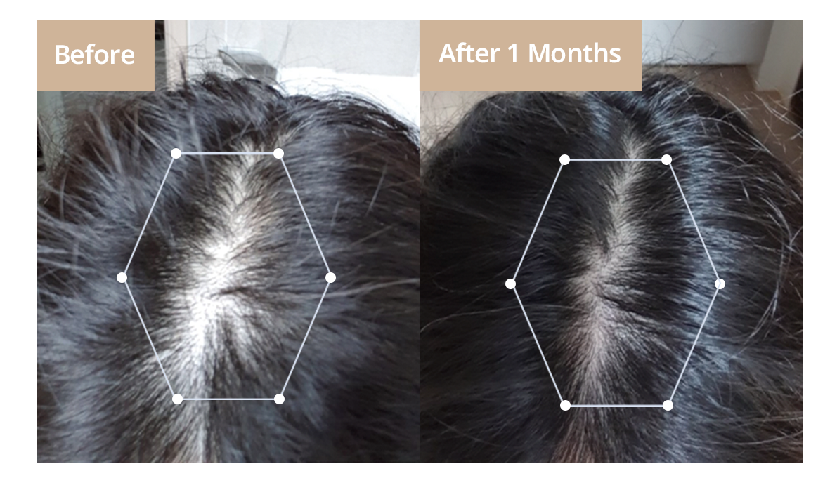Advanced Approach Of Using Matsutake Stem Cell Extract To Prevent Hair