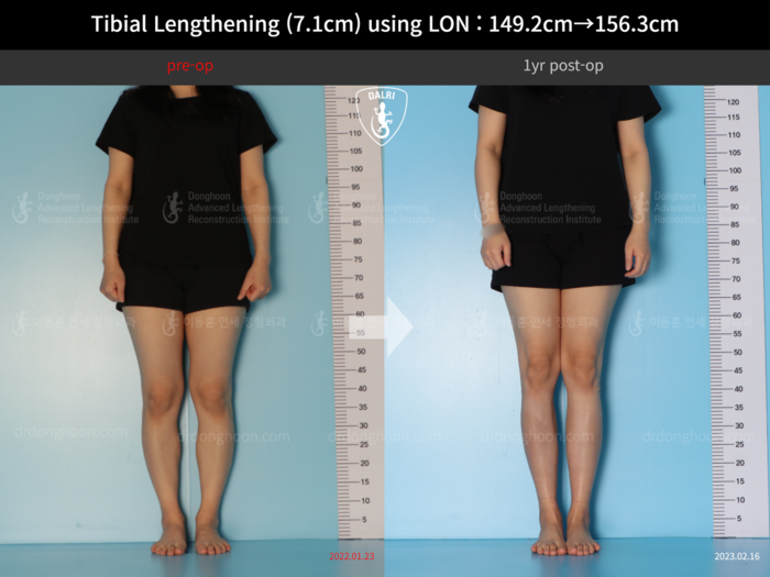 Tibial lengthening, 7.1 cm gained