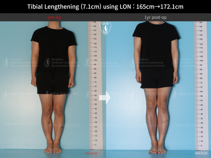 Tibial Lengthening (7.1cm) using LON : 165cm→172.1cm ; 1yr post-op