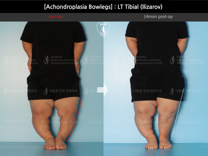 Tibial lengthening