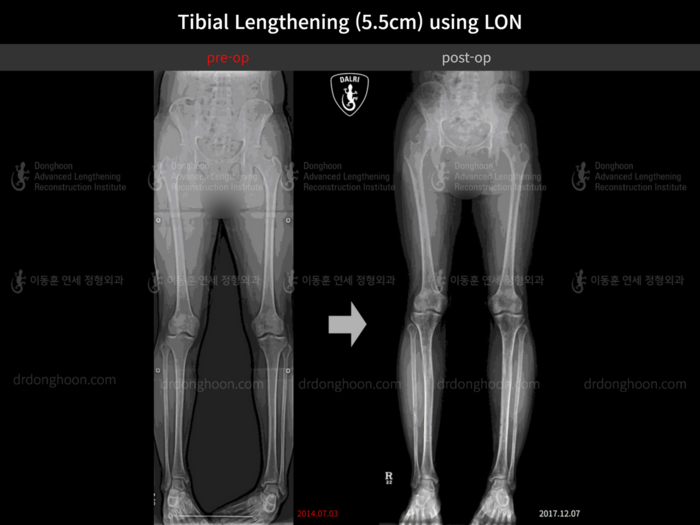Tibial lengthening, 5.5 cm gained