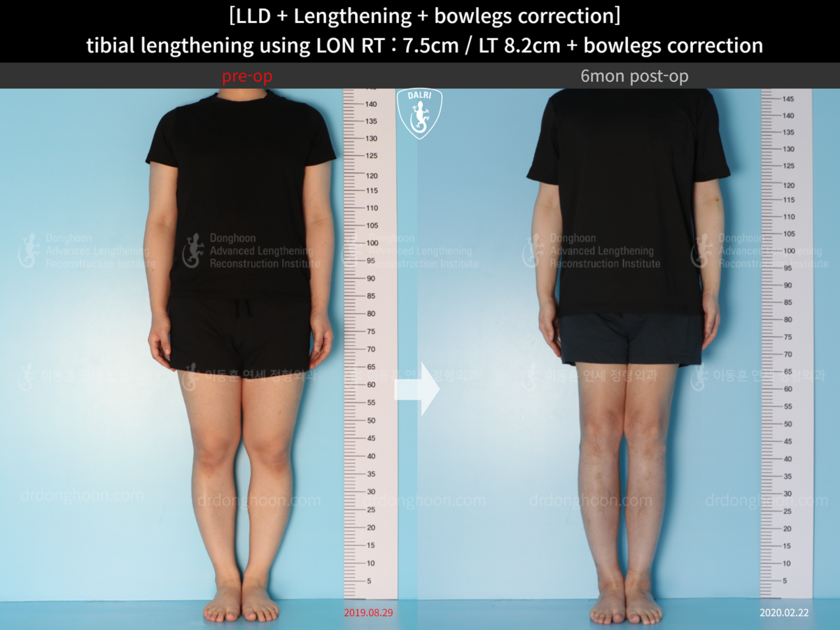 [LLD + Lengthening + Bowlegs Correction] Tibial Lengthening Using LON ...