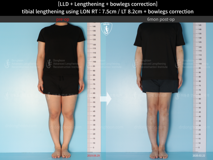 Tibial lengthening