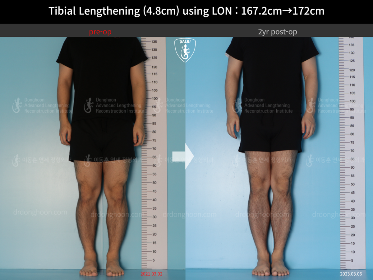 Tibial Lengthening (4.8cm) Using LON : 167.2cm→172cm : 2yr Post-op ...