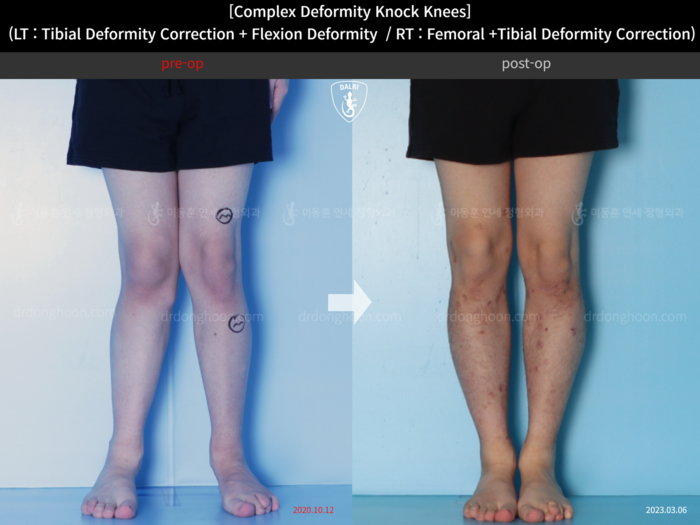 Femoral + tibial lengthening