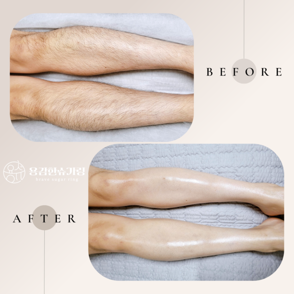 [인천 서구] 용감한슈가링왁싱