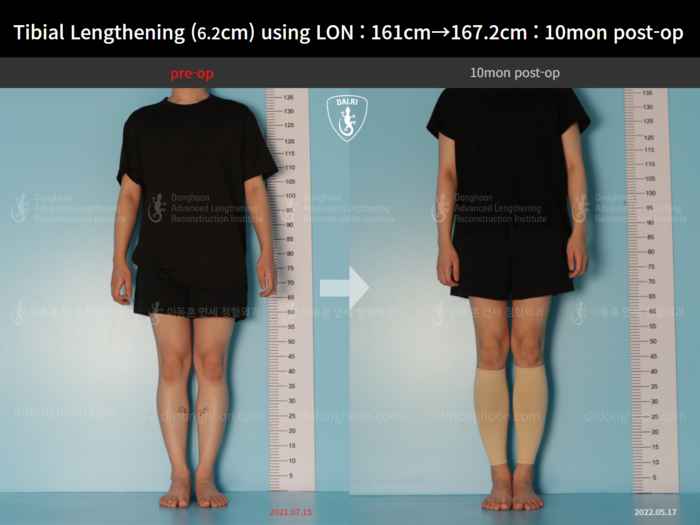 Tibial lengthening, 6.2 cm gained