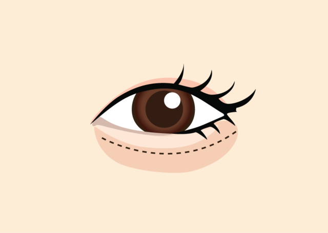 <br><p style="font-size: 20px;">속눈썹 아래로 최대한 흉터가 눈에<br>띄지 않게 피부를 절개</p>
