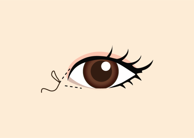 <br><p style="font-size: 20px;">몽고주름을 제거하고 흉터를<br>최소화하기 위해 섬세하게 봉합</p>