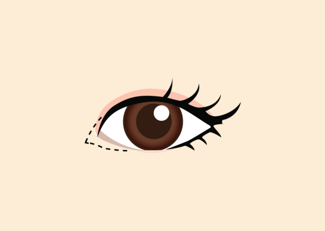 <br><p style="font-size: 20px;">몽고주름의 정도와 쌍커풀 라인을<br>고려하여 수술 디자인</p>