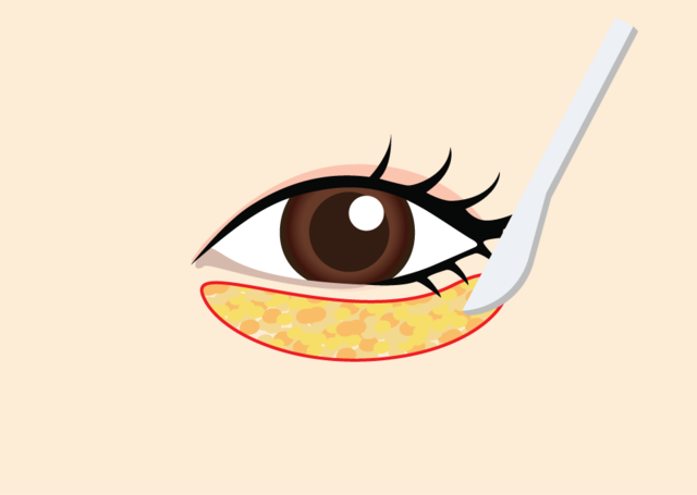 <br><p style="font-size: 20px;">일부 지방을 제거하며<br>지방을 재배치</p>