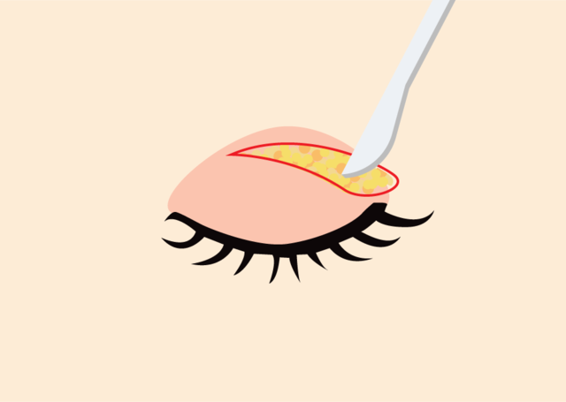 <br><p style="font-size: 20px;">눈꺼풀처짐을 발생시키는<br>피부조직과 지방 제거</p>