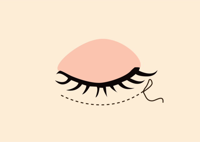 <br><p style="font-size: 20px;">수술부위를 봉합</p>