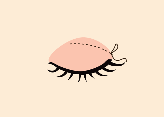 <br><p style="font-size: 20px;">눈뜨는 근육을 피부와<br>연결하여 봉합</p>