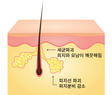 <p style="font-size: 20px;"><br>피지선과 여드름 균 파괴</p>