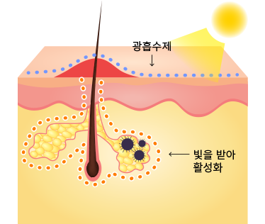 <p style="font-size: 20px;"><br>레이저 조사</p>