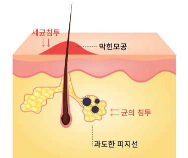 <p style="font-size: 16px;padding-top:10px;">여드름의 발생 원인</p>