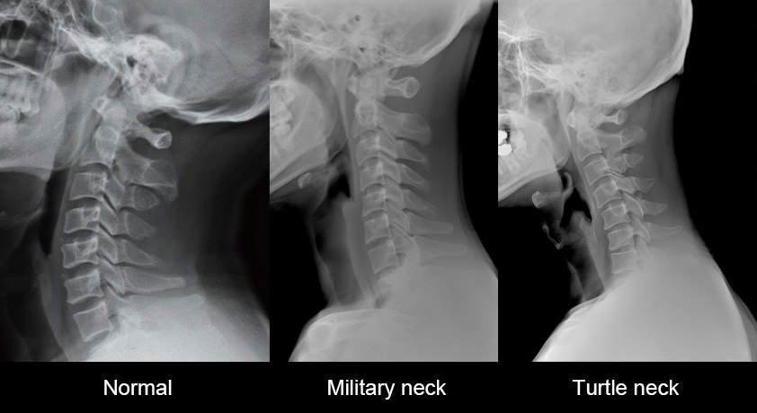 normal neck, military neck, turtle neck image
