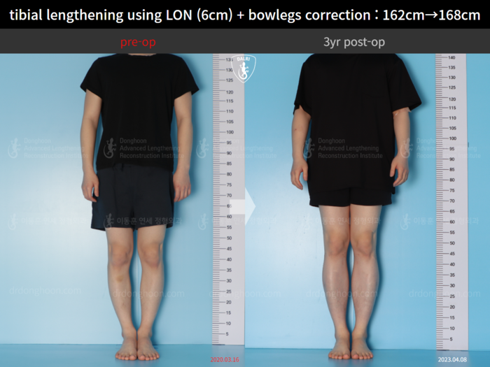 Tibial lengthening, 6 cm gained
