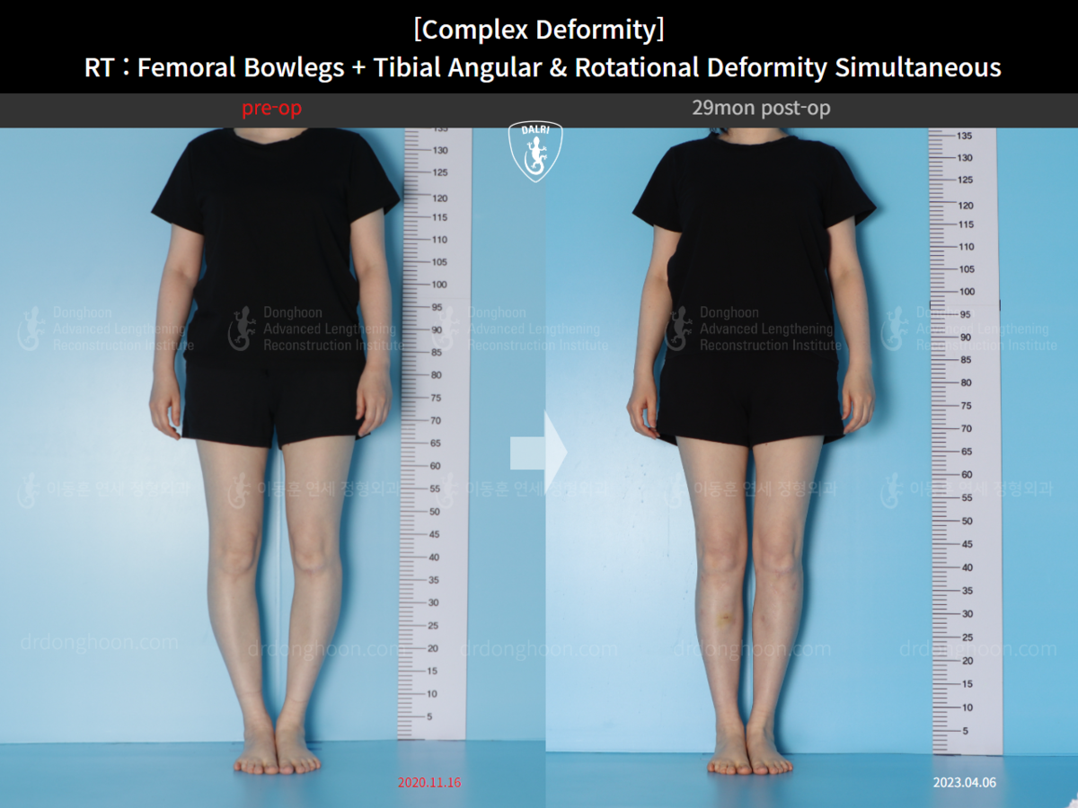 Deformity] RT Femoral Bowlegs + Tibial Angular & Rotational