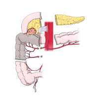 Colorectal resection 2 : INFOGRAPHY (인포그라피)