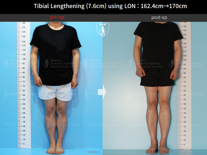 Tibial lengthening, 7.6 cm gained