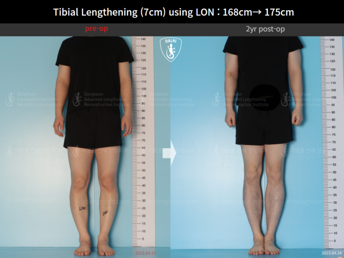 Tibial lengthening, 7 cm gained
