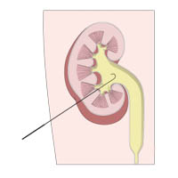 Pyelolithotomy 2 : INFOGRAPHY (인포그라피)