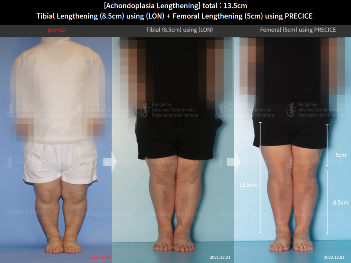 Femoral + tibial lengthening, 8.5 cm gained