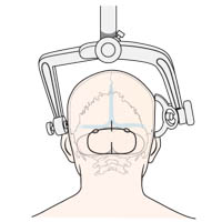 Midline suboccipital craniotomy : INFOGRAPHY (인포그라피)