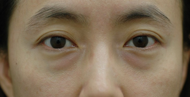 복합적인 증상의 눈 주변 노화가 시작되는 3,40대