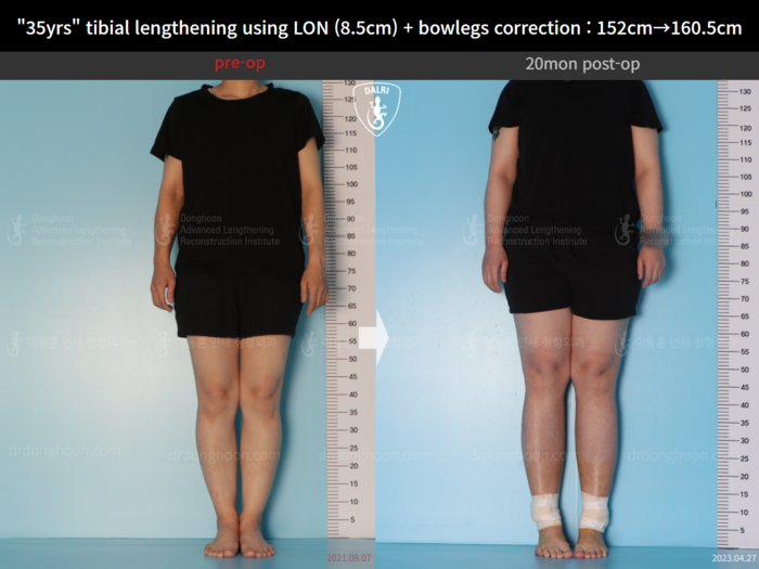 Tibial lengthening, 8.5 cm gained