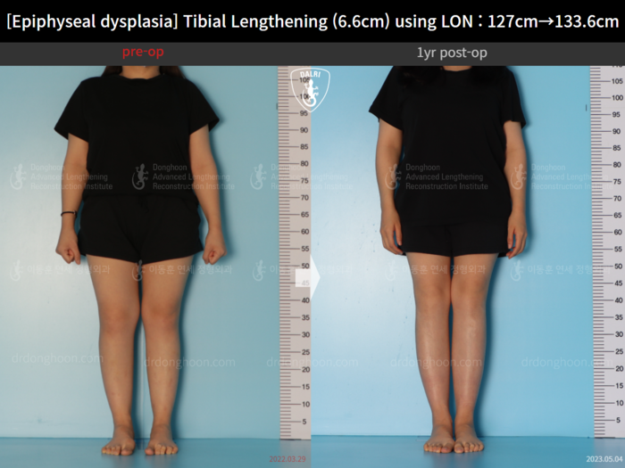 Tibial lengthening, 6.6 cm gained