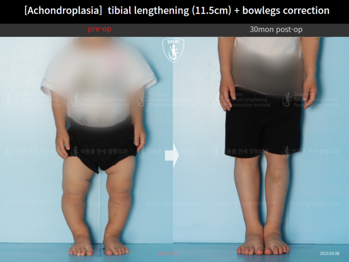 Tibial lengthening, 11.5 cm gained