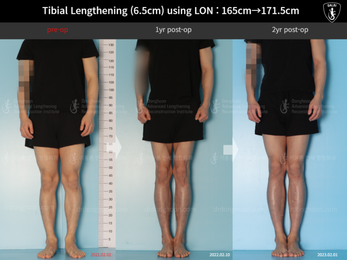Tibial lengthening, 6.5 cm gained