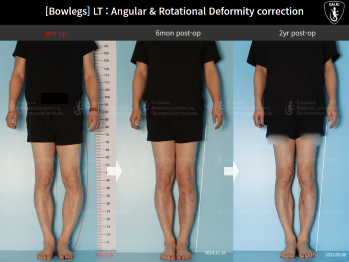 Adult bowlegs