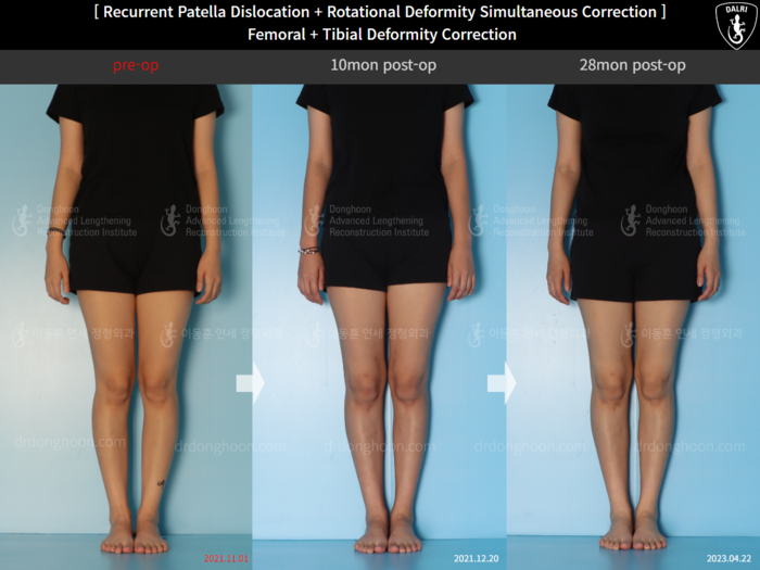 Femoral + tibial lengthening