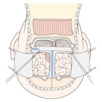 Midline suboccipital craniotomy : INFOGRAPHY (인포그라피)
