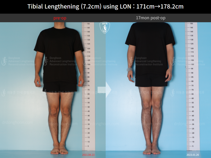 Tibial lengthening, 7.2 cm gained