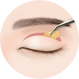 Upper Blepharoplasty Korea