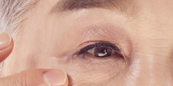 Aging Eyelid