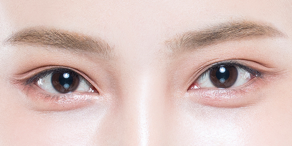 Ptosis Correction