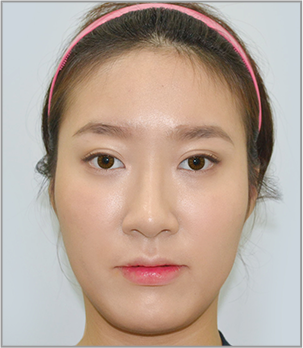 V-Line Face Contouring SurgeryMedisetter