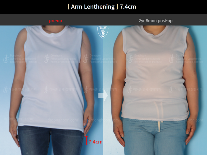 Arm lengthening