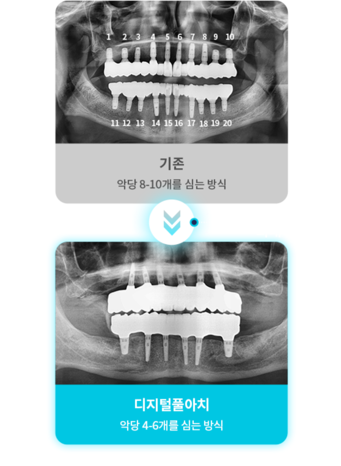 풀 아치 임플란트 맞춤형 시스템으로