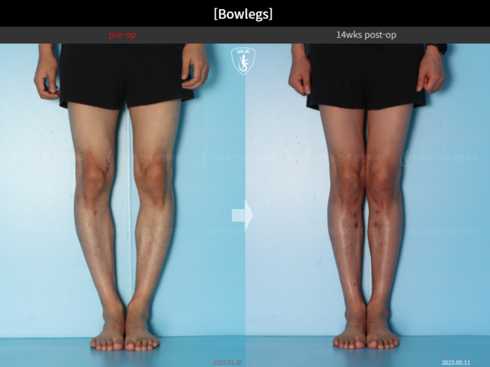 Adult bowlegs
