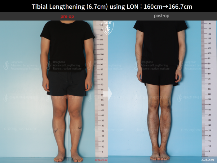 Tibial lengthening, 6.7 cm gained