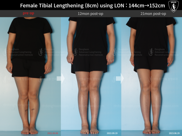 Tibial lengthening, 8 cm gained