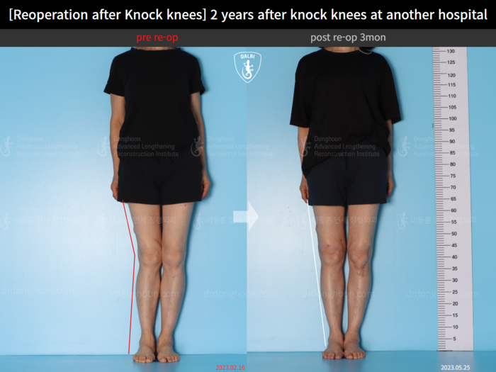 Reoperation after deformity correction