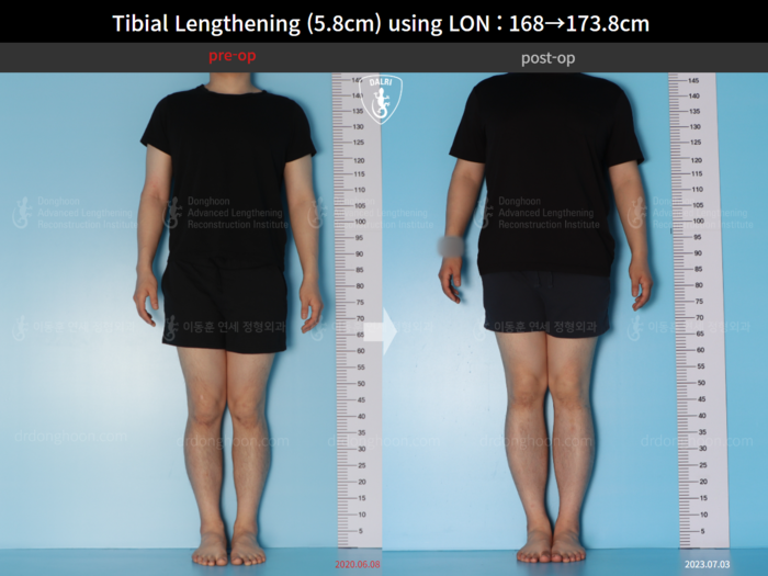 ยืดกระดูกหน้าแข้ง เพิ่มขึ้น 5.8 ซม.